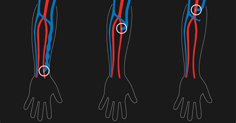 AV fistula for dialysis