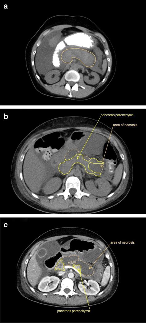 a Native abdominal CT scan with oral contrast dye at the day of... | Download Scientific Diagram