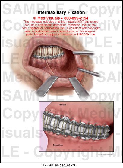 Intermaxillary Fixation Medical Exhibit Medivisuals