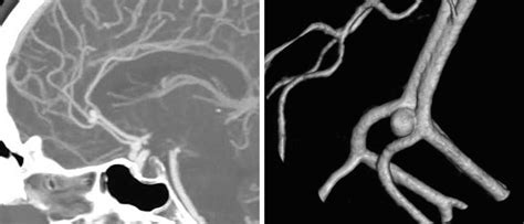 Pericallosal Artery Aneurysm | The Neurosurgical Atlas