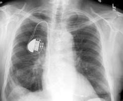 FDA Approves First MRI-Compatible Pacemaker