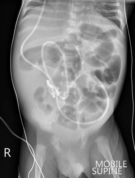 A rare complication of ventriculoperitoneal shunt in a neonate ...