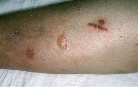 Diabetic blisters pictures 1 | Symptoms and pictures