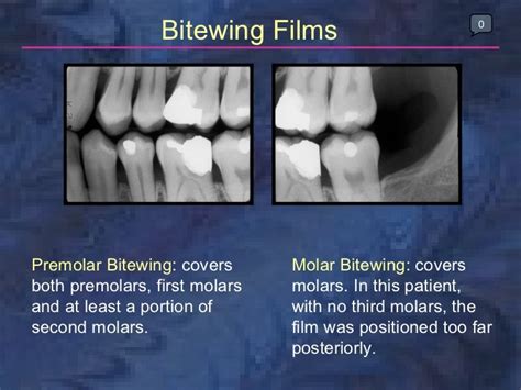 radiology-bitewing-technique