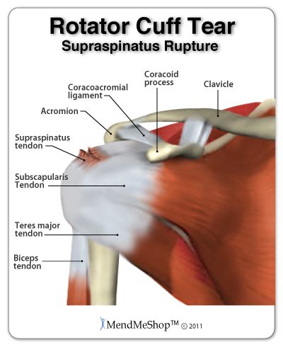 Ruptured Rotator Cuff