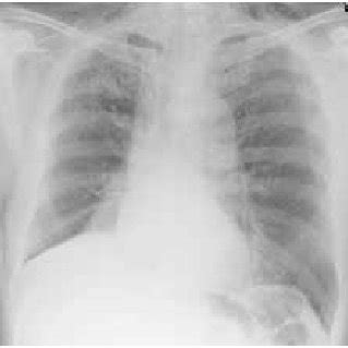 (PDF) Swollen neck and crepitus after bouts of cough