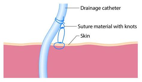 Ir Drainage Of Abscess