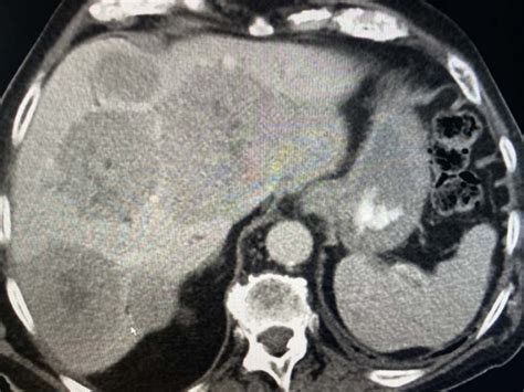 Liver Masses On CT Scan – Radiology In Plain English