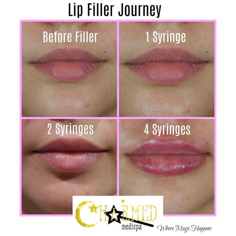 One Two or Four Syringes Filler Lip Results – Charmed Medispa
