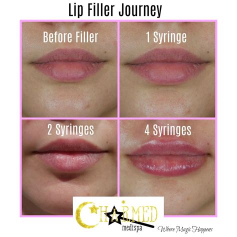 One Two or Four Syringes Filler Lip Results – Charmed Medispa