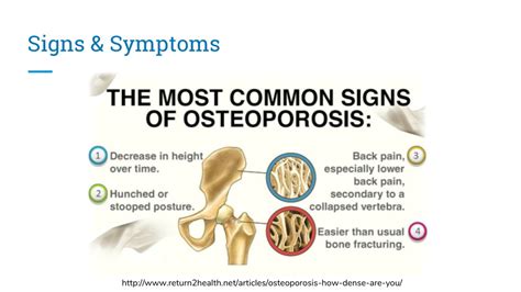 PPT - Osteoporosis PowerPoint Presentation, free download - ID:8828388