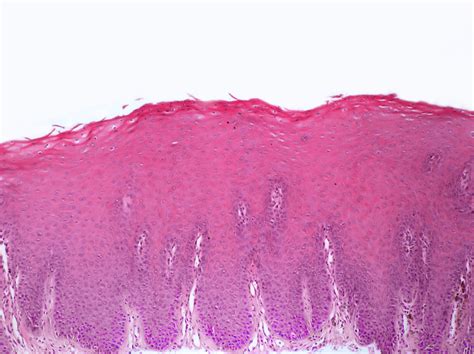 Oral Candidiasis Histology