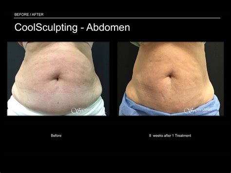 Before & After Photos Of Coolsculpting Treatment Results