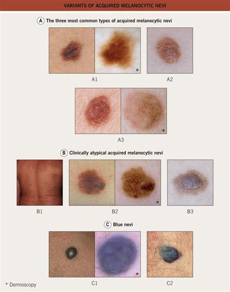 Benign Melanocytic Neoplasms | Plastic Surgery Key