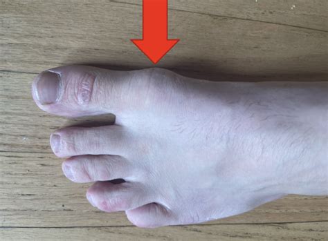 Big Toe Pain: 5 Causes of a Painful Big Toe - Dr. Justin Dean