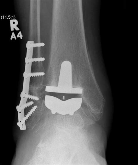 Ankle Arthroplasty | The Bone School