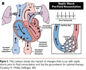 Septic Shock Fluid Resuscitation | Epomedicine