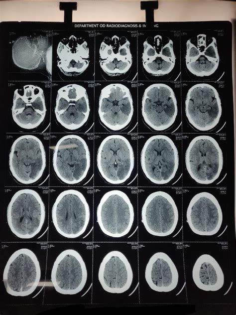 Case of Right sided hemiplegia,