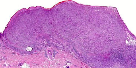 Nodular Malignant Melanoma