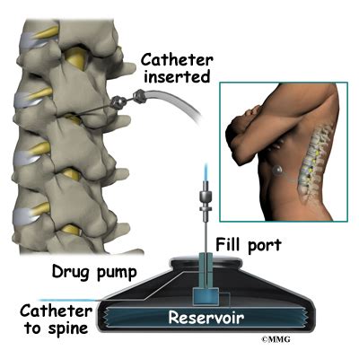 Pain Pumps | eOrthopod.com