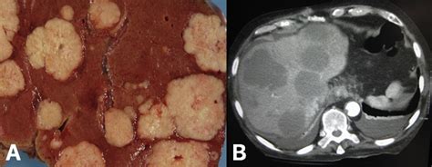 Liver Cancer - Hepatocellular Carcinoma - Secondary - TeachMeSurgery