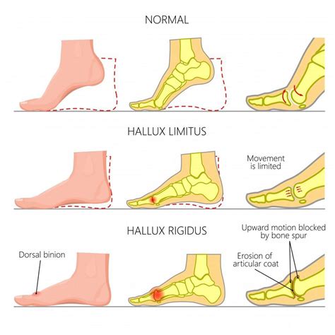 Does Your Big Toe Hurt? It Could Be Arthritis (Hallux Rigidus): Eugene ...