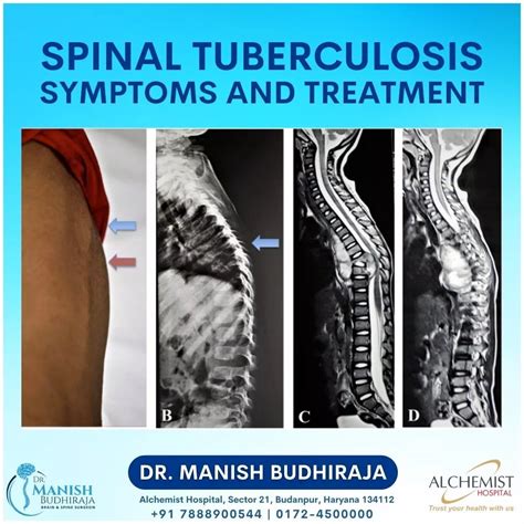 Spinal Tuberculosis Symptoms And Treatment - Neurosurgeon in Chandigarh