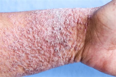 Atopic Dermatitis AD, Also Known As Atopic Eczema, is a Type of Inflammation of the Skin ...