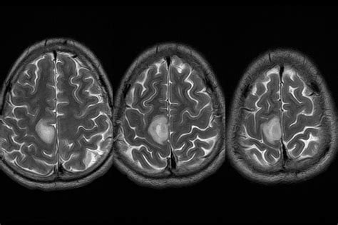 Parietal Lobe Mri