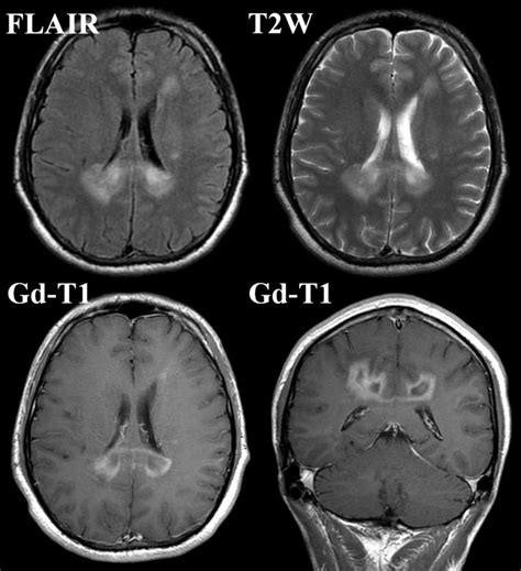 Tumefactive multiple sclerosis requiring emergent biopsy and ...