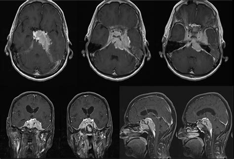 Management of Petroclival Meningiomas: Subtotal Resection and Radiosurgery vs. Total Removal ...