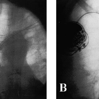 (PDF) Stent implantation for the treatment of superior vena cava syndrome related to pacemaker leads