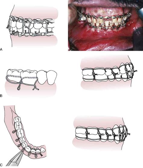 and Maxillofacial Surgery | Basicmedical Key