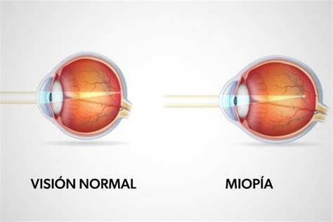Miopía: qué es, causas y tratamiento - Tua Saúde