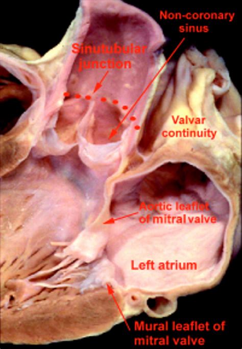 Clinical anatomy of the aortic root | Heart