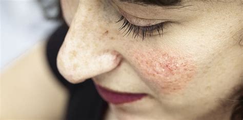 Effective Acne Rosacea Treatment in Los Angeles | Dr. Brian Mekelburg