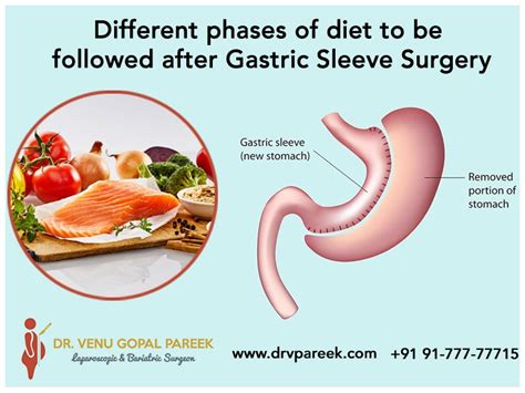 Different phases of diet to be followed after Gastric Sleeve Surgery