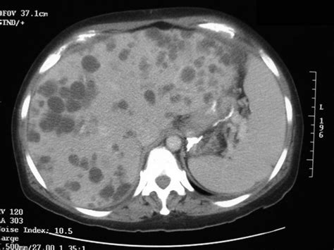 Clinical Cases and Images: Adult Polycystic Kidney Disease (APKD) with Cysts in Kidneys and Liver