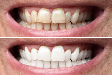 Teeth Whitening - Smiles That Matter