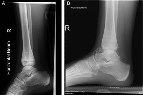 Dystrophic calcification of the ankle joint following intra-articular corticosteroid injections ...