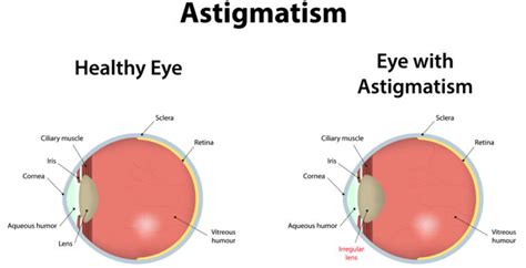 Astigmatism Symptoms & 3 Natural Treatments - David Avocado Wolfe