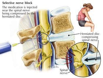 Targeted Epidural Injections - Medford, NY: Pain Management of Long Island