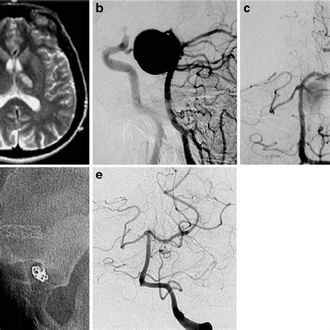 A 47-year-old female presented with headache, left-sided anisocoria,... | Download Scientific ...