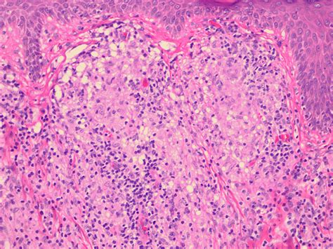 leprosy skin histology