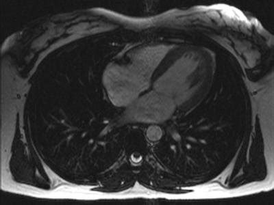 Magnetic Resonance Imaging (MRI) - Cardiac (Heart)