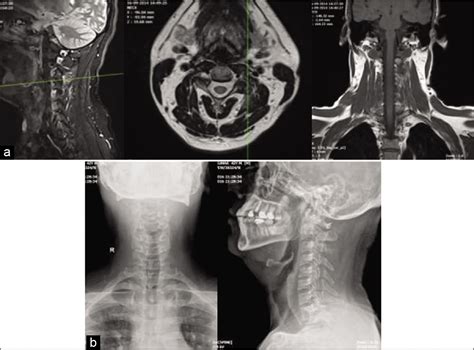 Osteoid Osteoma Mri Spine