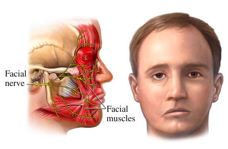 Symptoms and Treatment for Facial Nerve Damage - ENT Clinic Sydney