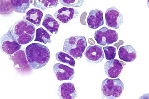 Acute Myeloid Leukemia Cells