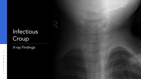 Infectious Croup X-ray: Steeple Sign - YouTube