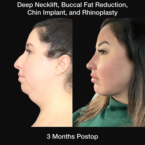 Buccal Fat Removal Local Anesthesia at Valerie Fisher blog